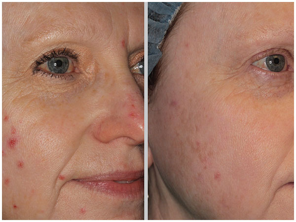 BBL Acne Laser Treatment Before and After