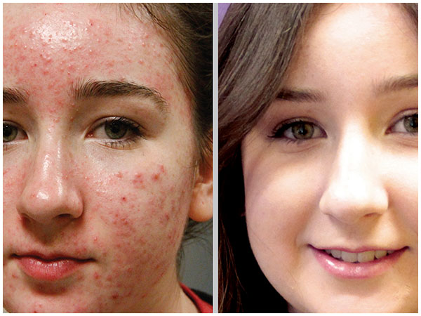 BBL Acne Laser Treatment Before and After