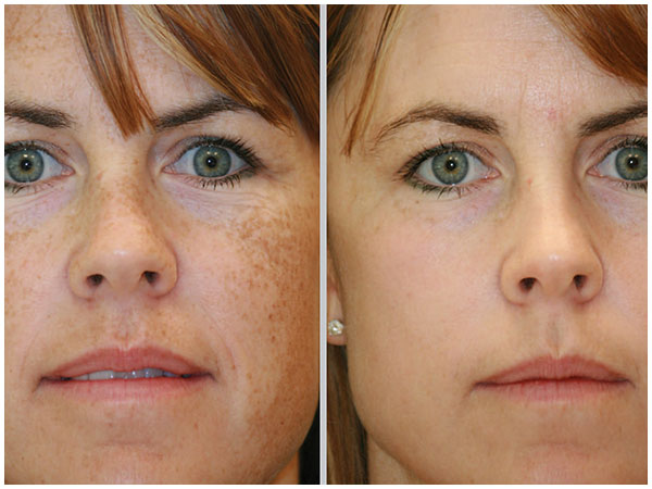 BBL Photofacial Laser Treatment Before and After