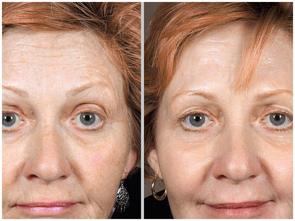 Deep Resurface TRL Laser Treatment Before and After