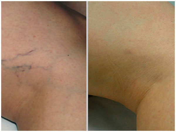 Leg Vein Laser Treatment Before and After