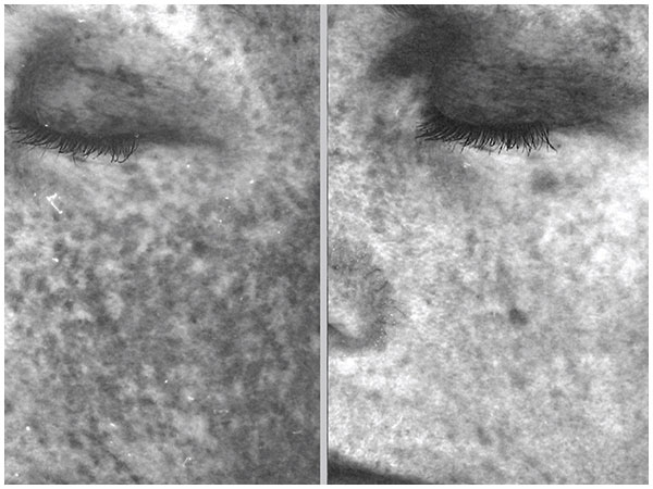 BBL Photofacial Treatment Before and After