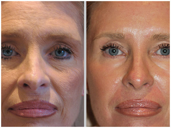 BBL Photofacial Treatment Before and After