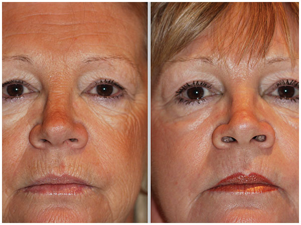 Combination Treatments Laser Treatment Before and After