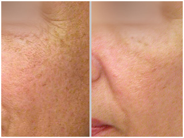 Nano Laser Peel Laser Treatment Before and After