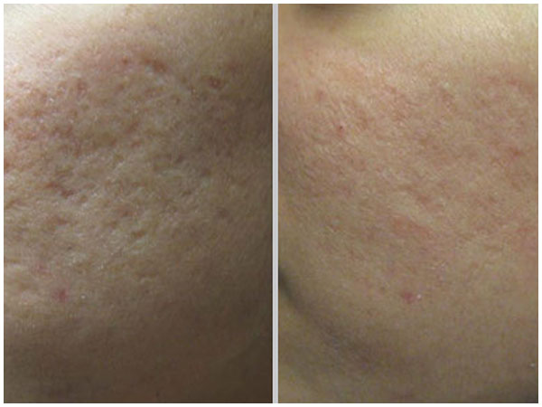 Pixel Perfect Laser Treatment Before and After