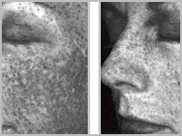 Microlaser Before and After